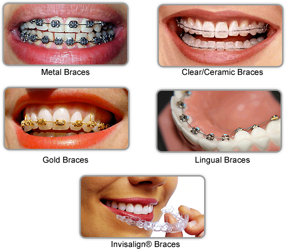 teeth braces types adults