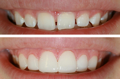 dental veneers