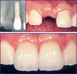 dental implants croatia