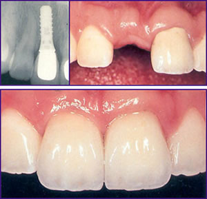 dental implants croatia