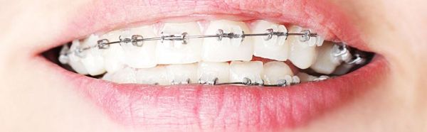 ortodontski aparatić