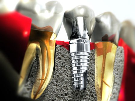 dentalni implantati