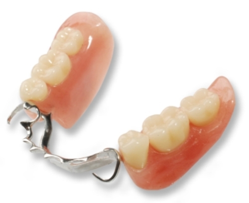 parcijalna zubna proteza