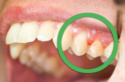 upala-zubnog-mesa-gingivitis