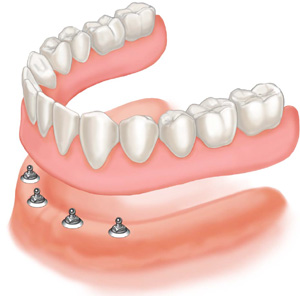 Zubne proteze na implantatima